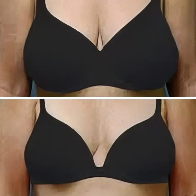 Breast Reduction - Before & After