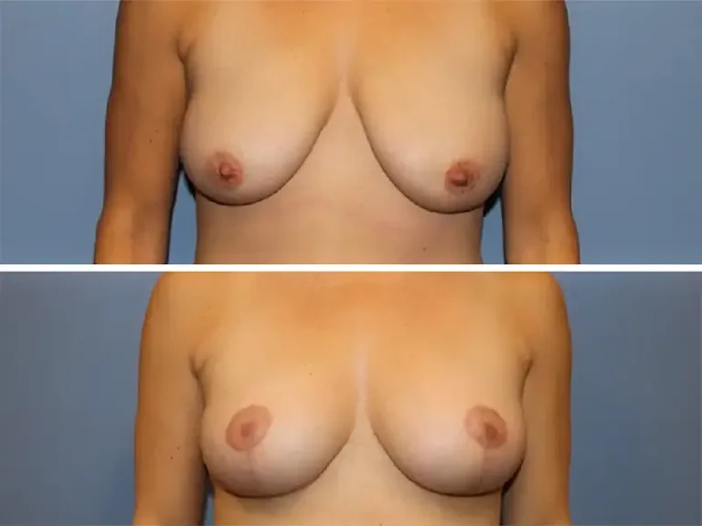 Breast Reduction