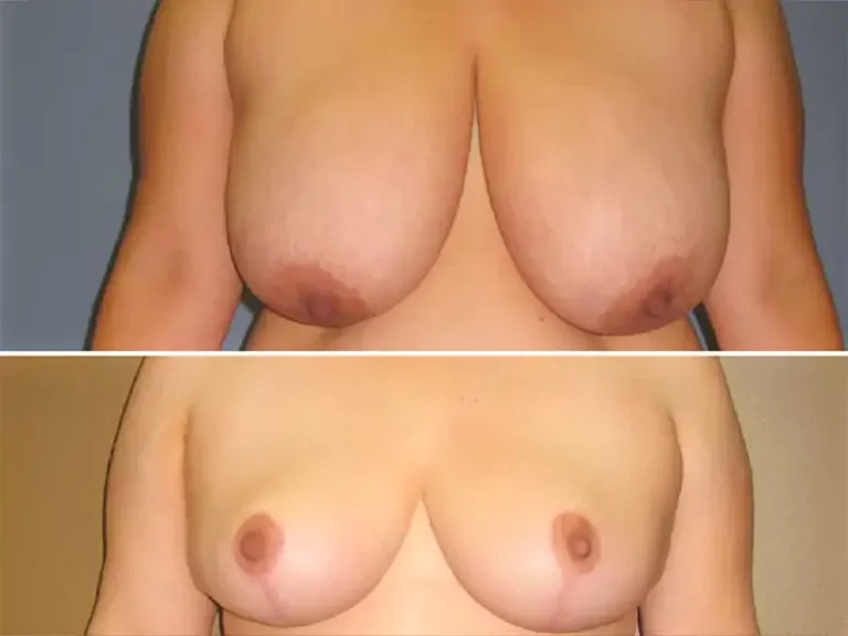 Breast Reduction