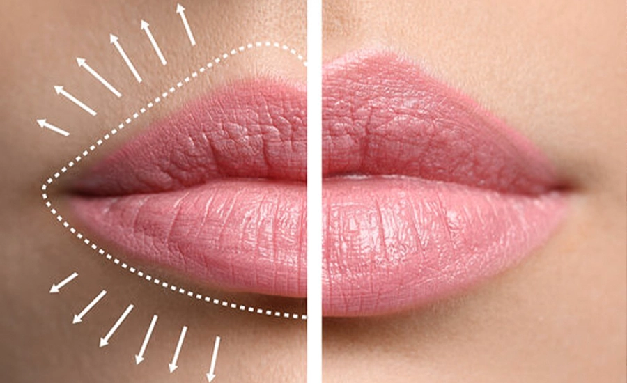 Llip Lift, Llip Lift in Antalya, Medical Tourism Turkey