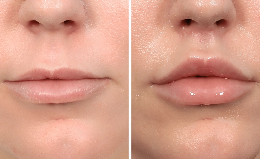 Llip Lift, Llip Lift in Antalya, Medical Tourism Turkey