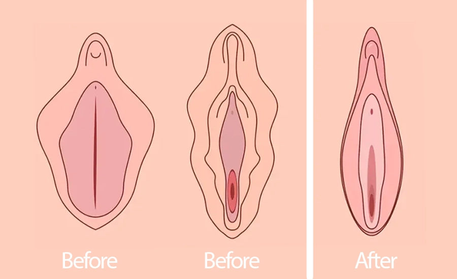 Health in Antalya, Medical Tourism Turkey, Vaginoplasty