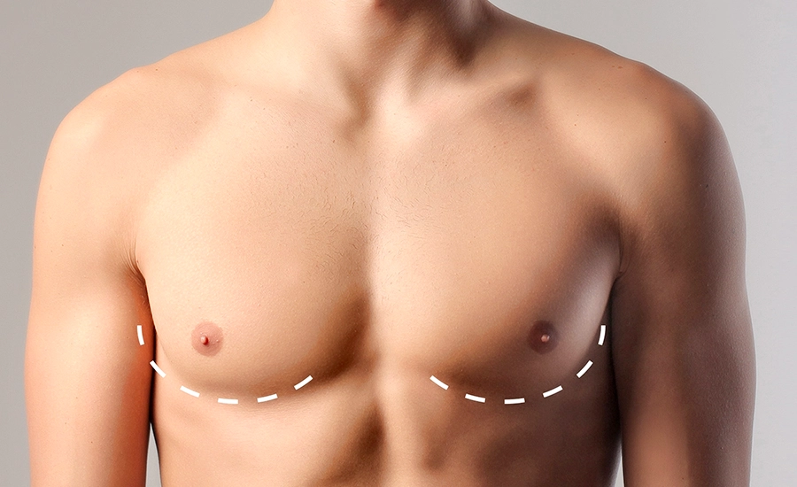 Gynecomastia, Health in Antalya, Medworld Clinic, Male Breast Enlargement