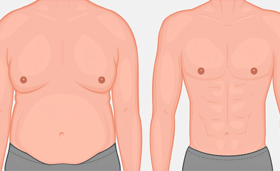 Gynecomastia, Health in Antalya, Medworld Clinic, Male Breast Enlargement