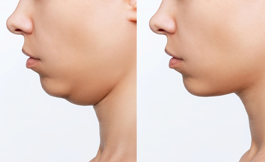 Double Chin Liposuction, Medical Tourism Turkey, MTT, Double Chin Liposuction in Antalya
