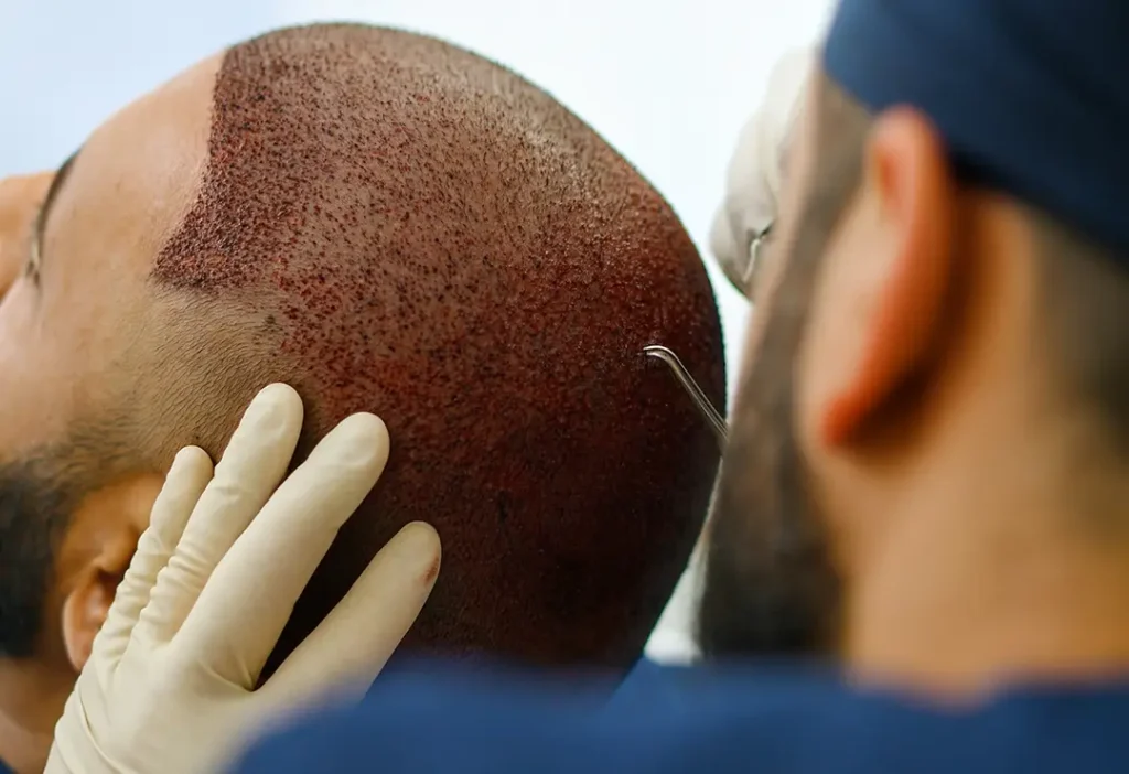 Hair Transplant in Turkey Antalya