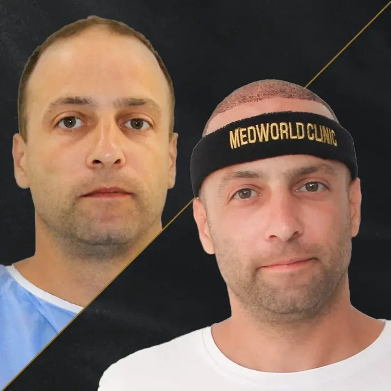 hair-transplant-2