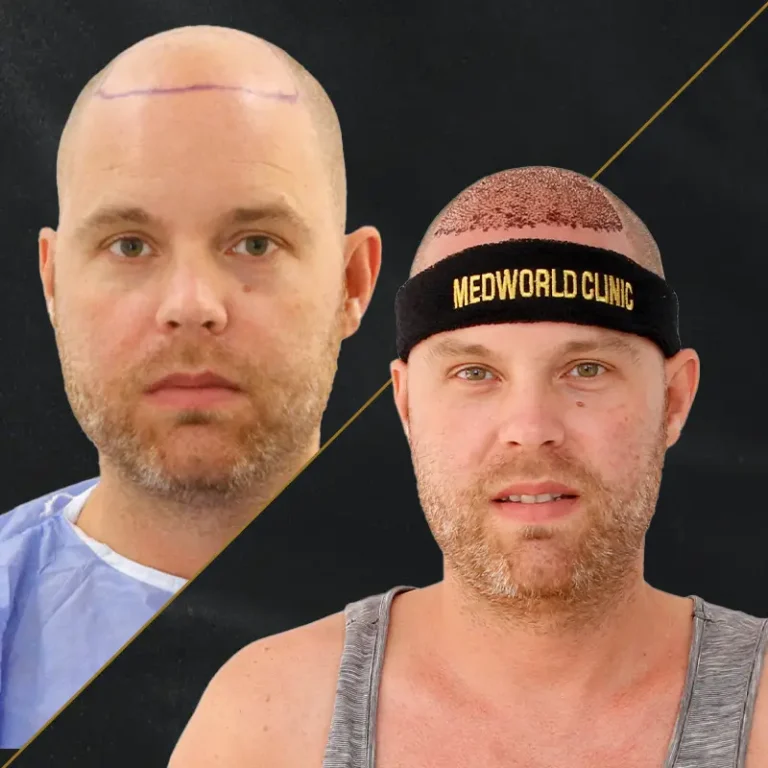 Beste Haartransplantation in der Türkei, Antalya