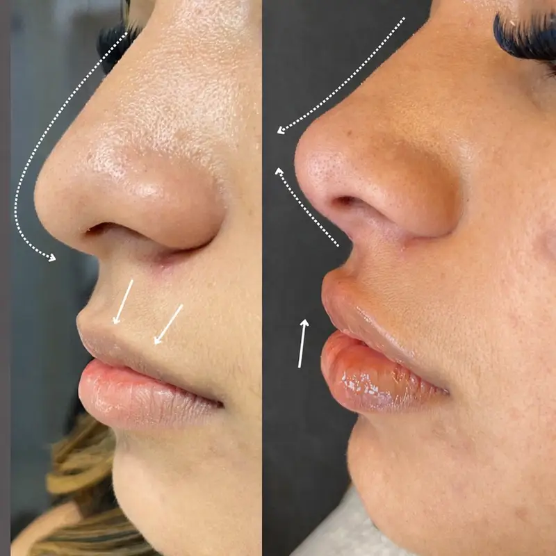 Rhinoplasty in Antalya, Turkey