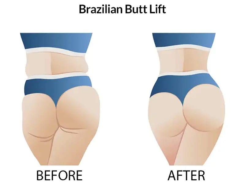 BBL + Back Liposuction in Turkey