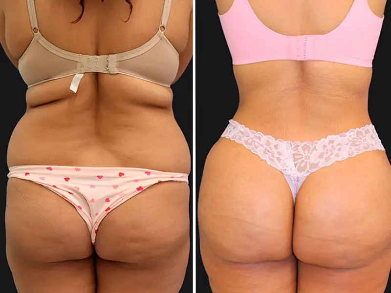 BBL + Back Liposuction in Turkey