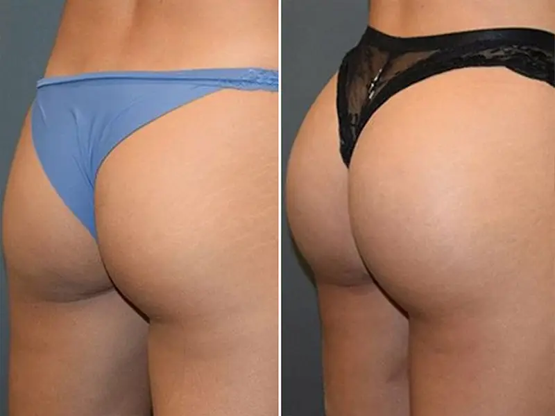 BBL + Back Liposuction in Turkey