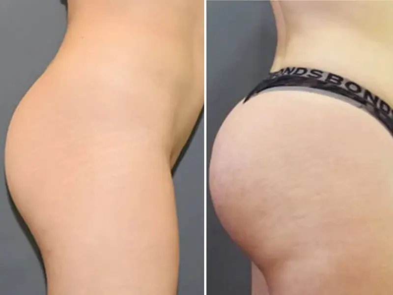 BBL + Back Liposuction in Turkey
