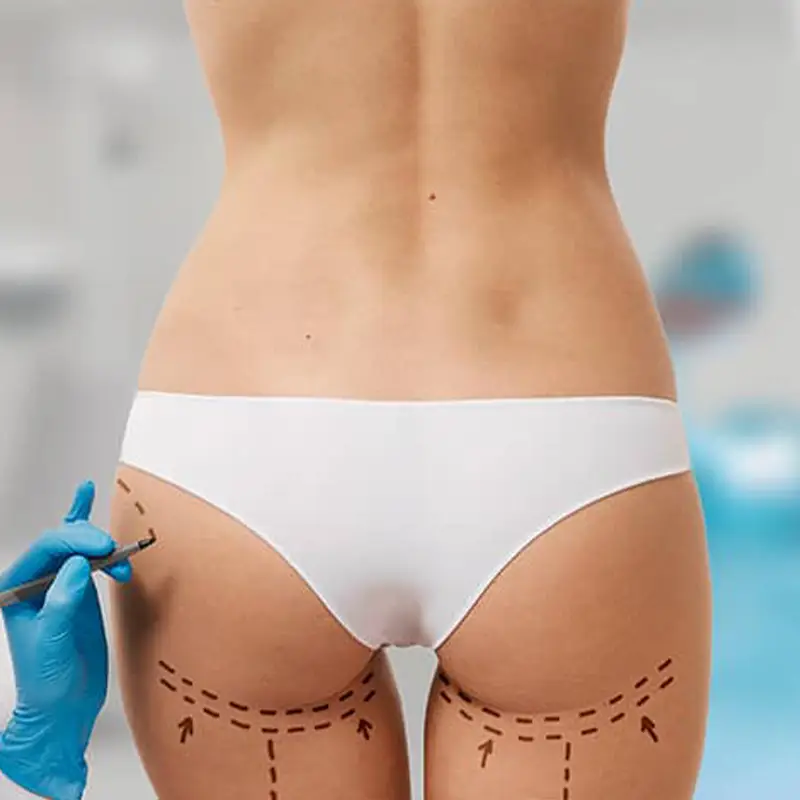 BBL + Back Liposuction in Turkey