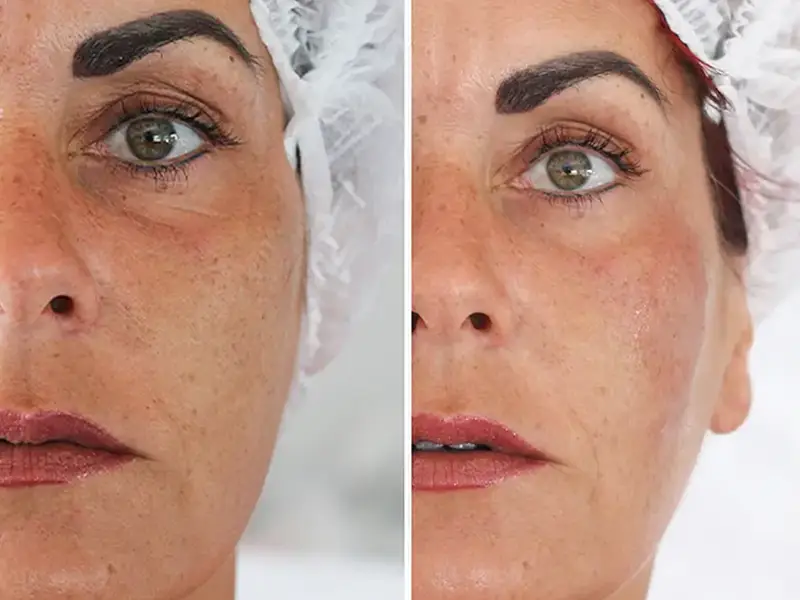 Full Facelift in Antalya, Turkey