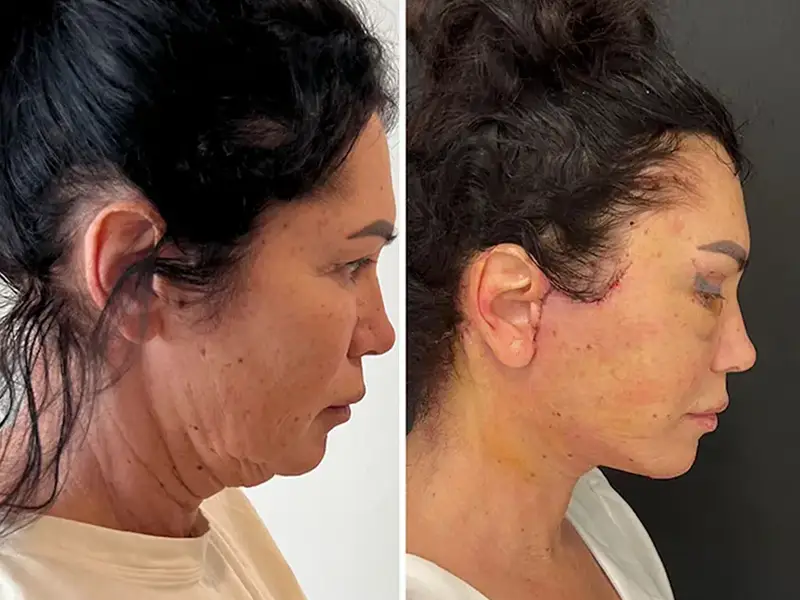 Full Facelift in Antalya, Turkey