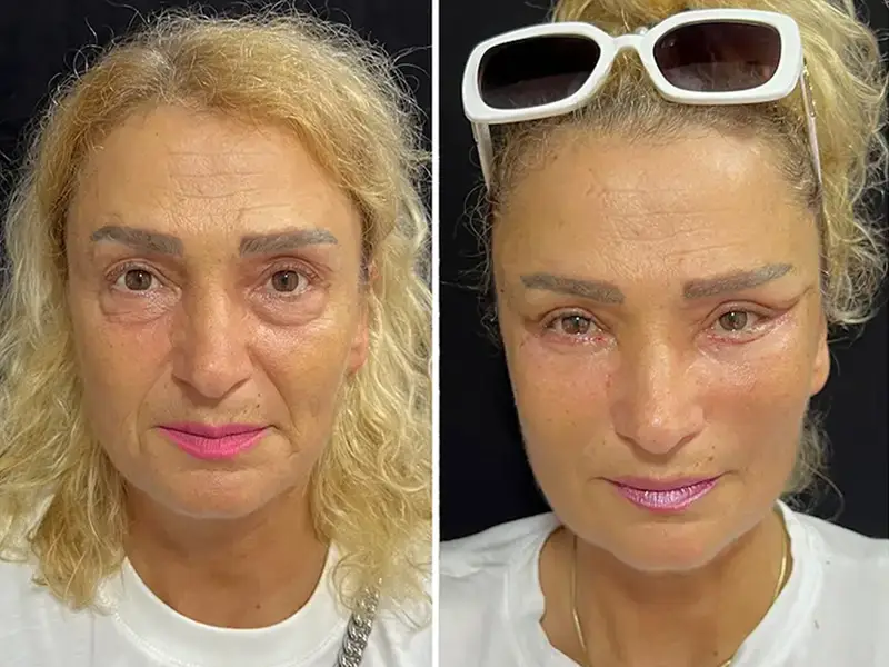 Full Facelift in Antalya, Turkey