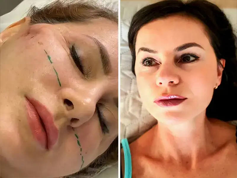 Full Facelift in Antalya, Turkey