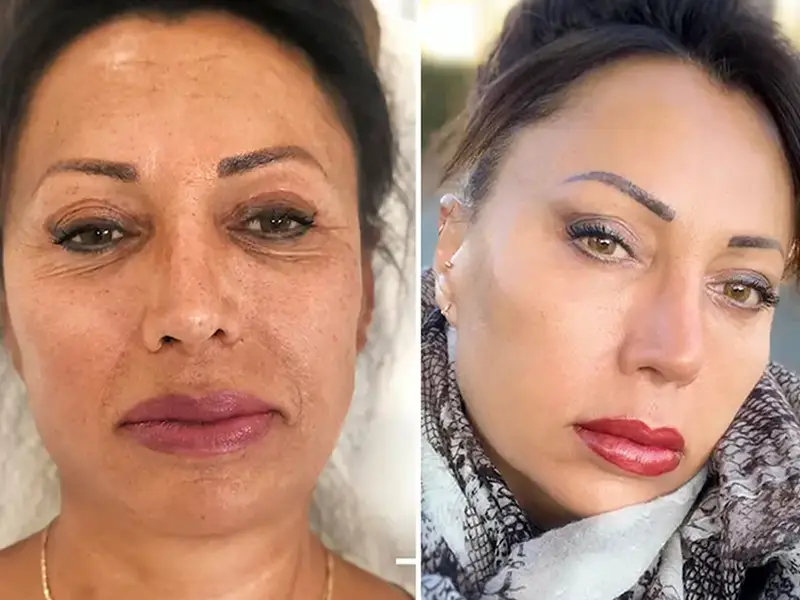 Full Facelift in Antalya, Turkey