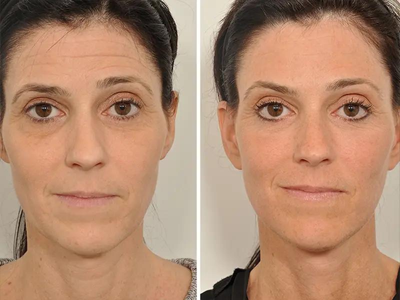 Full Facelift in Antalya, Turkey
