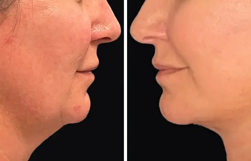 Full Facelift in Antalya, Turkey