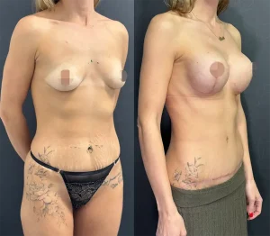 Mommy Makeover