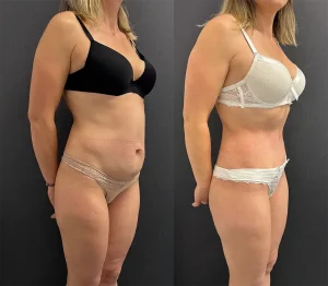 Mommy Makeover