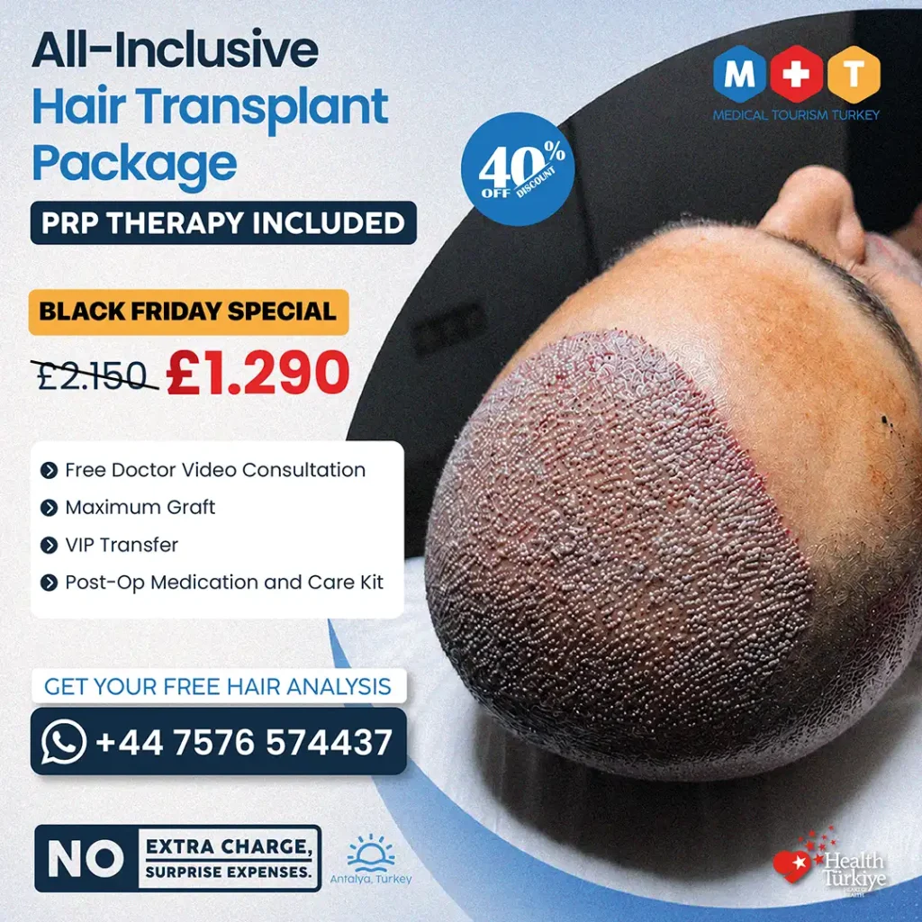 All-Inclusive Hair Transplant in Turkey