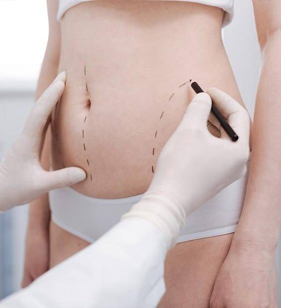 Liposuktion - Medical Tourism Turkey